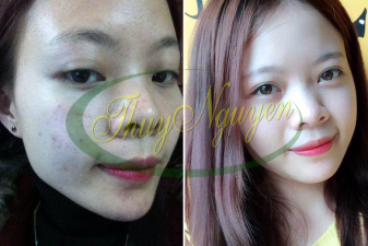 Liệu Trỉnh Điều Trị Mụn Nặng - Mụn Ẫn - Mụn Đầu Đen - Mụn Mũ - MSKH 15106